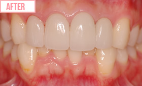 セラミック矯正施術後1