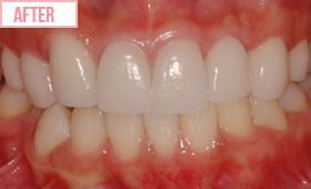 アクトレス矯正施術後1