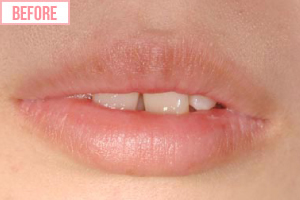 セラミック矯正施術前2