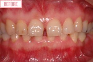 歯に貼るセラミック1歯施術前