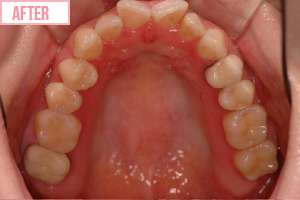 小さいむし歯 強化プラスチック充てん施術後