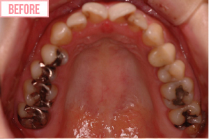 小さいむし歯 強化プラスチック充てん施術前