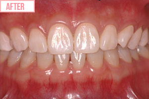 ホワイトニング施術後1