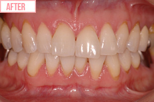 ホワイトニング施術後2