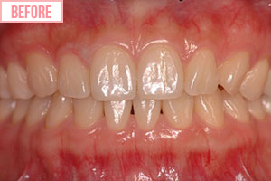 ホワイトニング施術前1