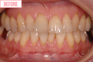 ホワイトニング施術前2