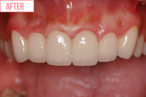 歯ぐきの整形施術後3