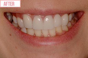 クトレス矯正6施術後