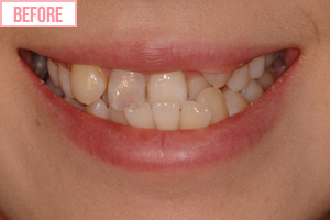 クトレス矯正6施術前