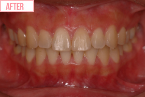 ダイエット矯正施術後