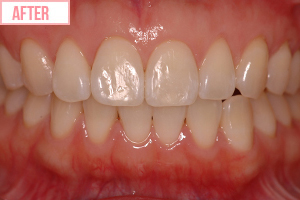 短期ワイヤー矯正施術後