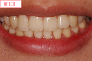 通常期ワイヤー矯正施術後1