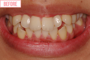 通常期ワイヤー矯正施術前1