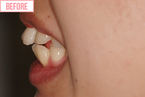 通常期ワイヤー矯正施術前2