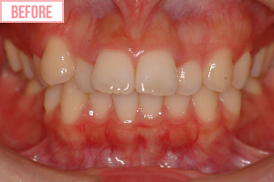 片側 通常期ワイヤー矯正施術前1