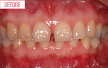 ラミネートべニアのbefore