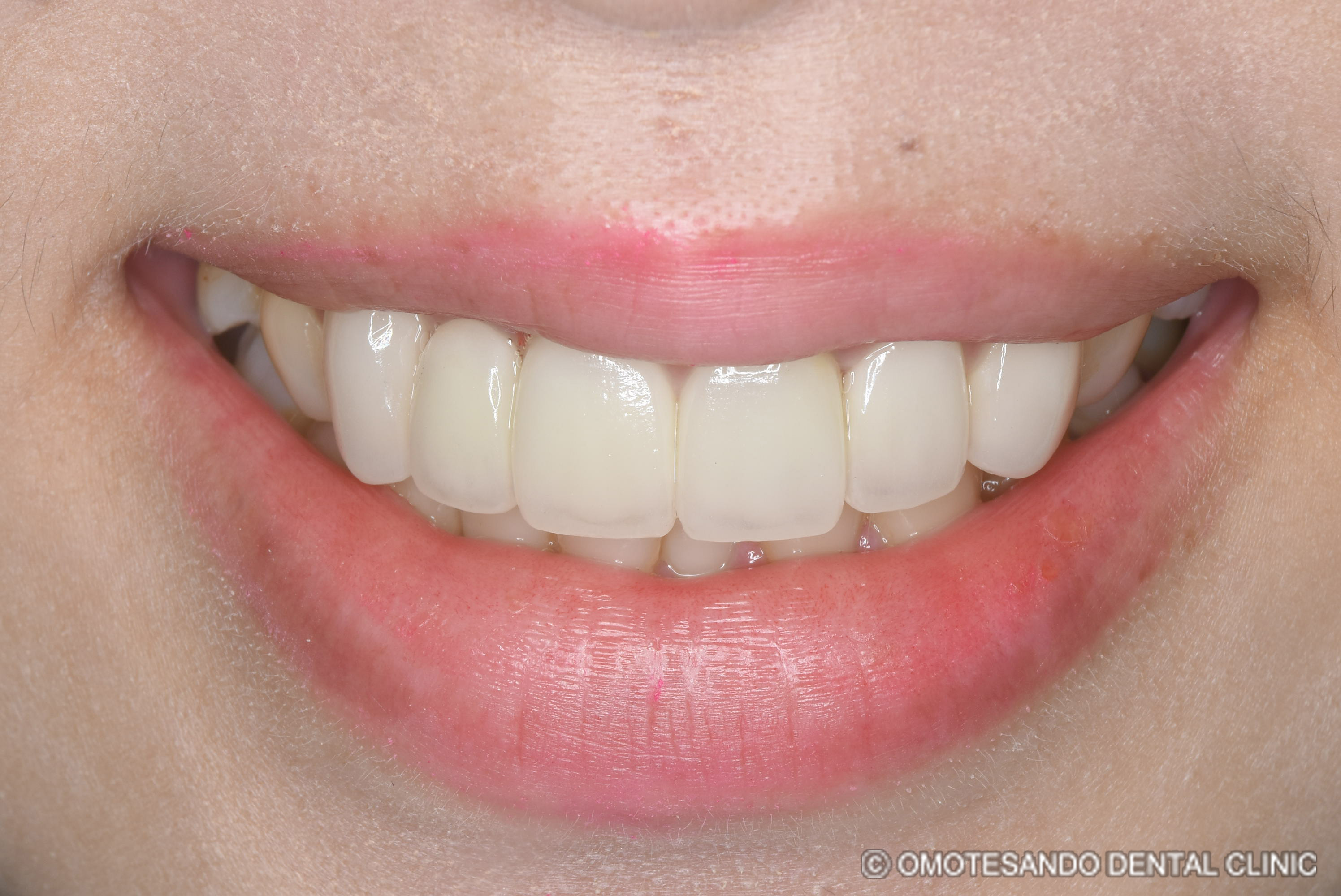 ガミースマイルアクトレス矯正30代女性_フロント_after