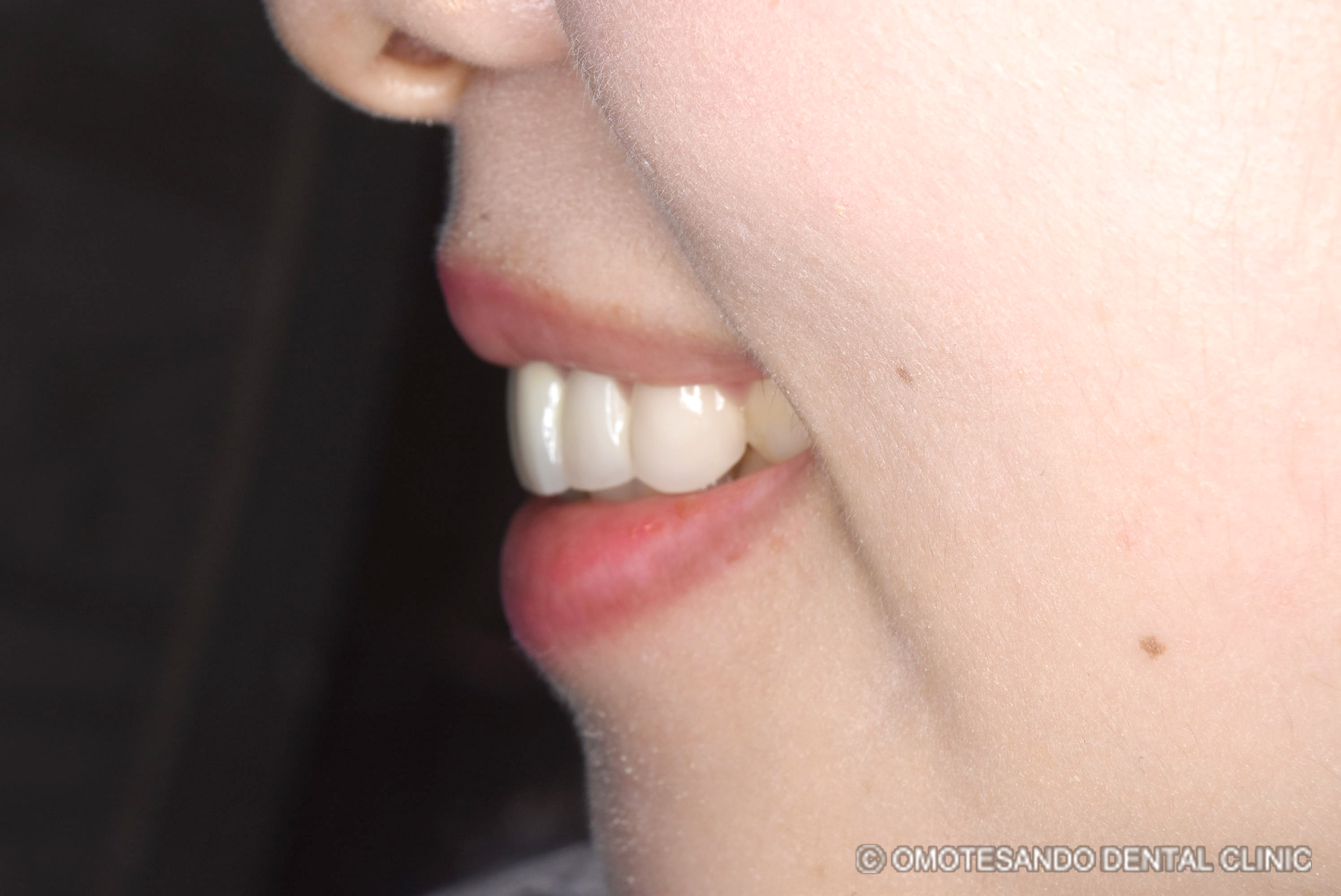 ガミースマイルアクトレス矯正30代女性_サイド_after