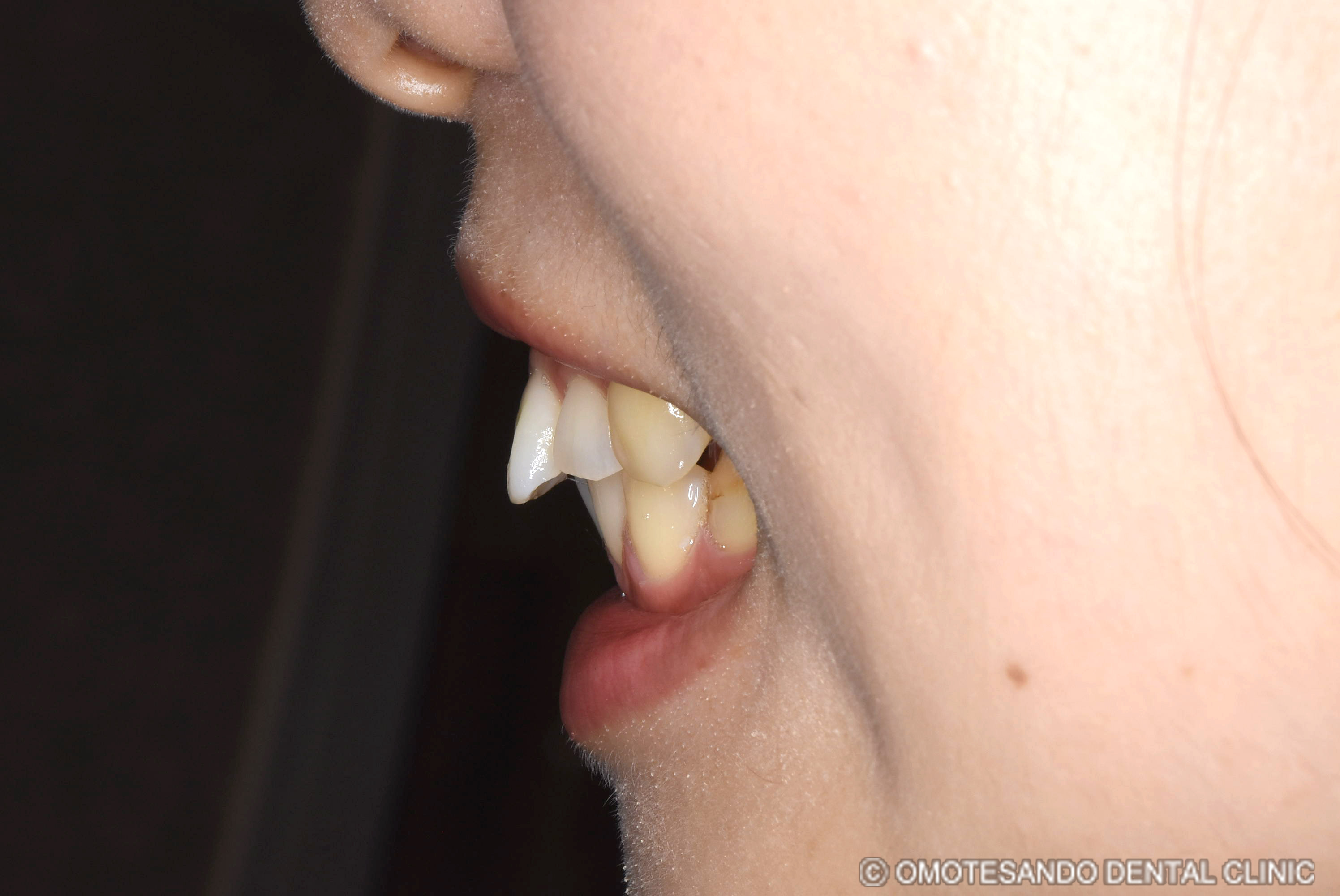 ガミースマイルアクトレス矯正30代女性_サイド_before