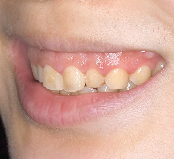 ガミースマイル