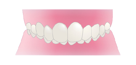 過蓋咬合（ディープバイト）