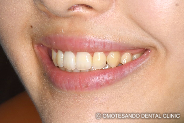 ガミースマイルワイヤー矯正（圧下矯正）20代女性_斜め_after