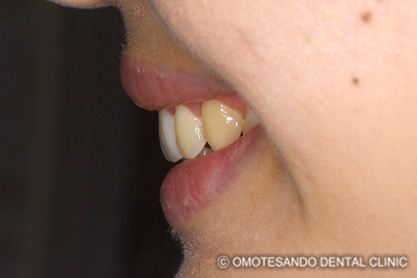 ガミースマイルワイヤー矯正（圧下矯正）20代女性_サイド_after