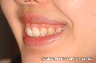 ガミースマイルワイヤー矯正（圧下矯正）20代女性_斜め_before