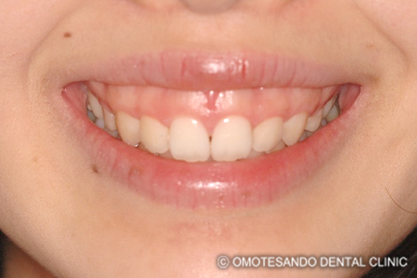 ガミースマイルワイヤー矯正（圧下矯正）20代女性_フロント_before