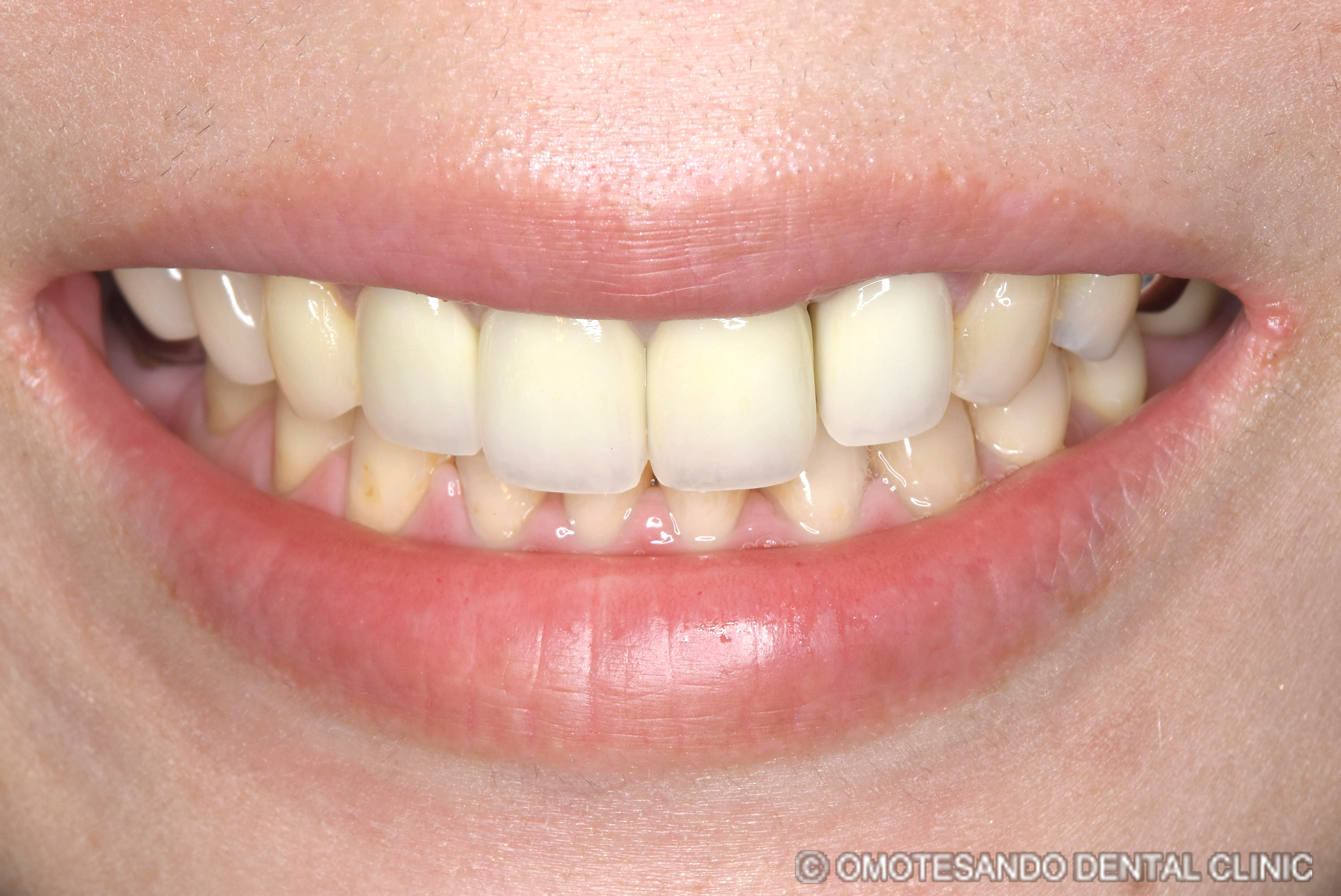 ガミースマイルワイヤー矯正＋セラミック矯正30代女性_フロント_after