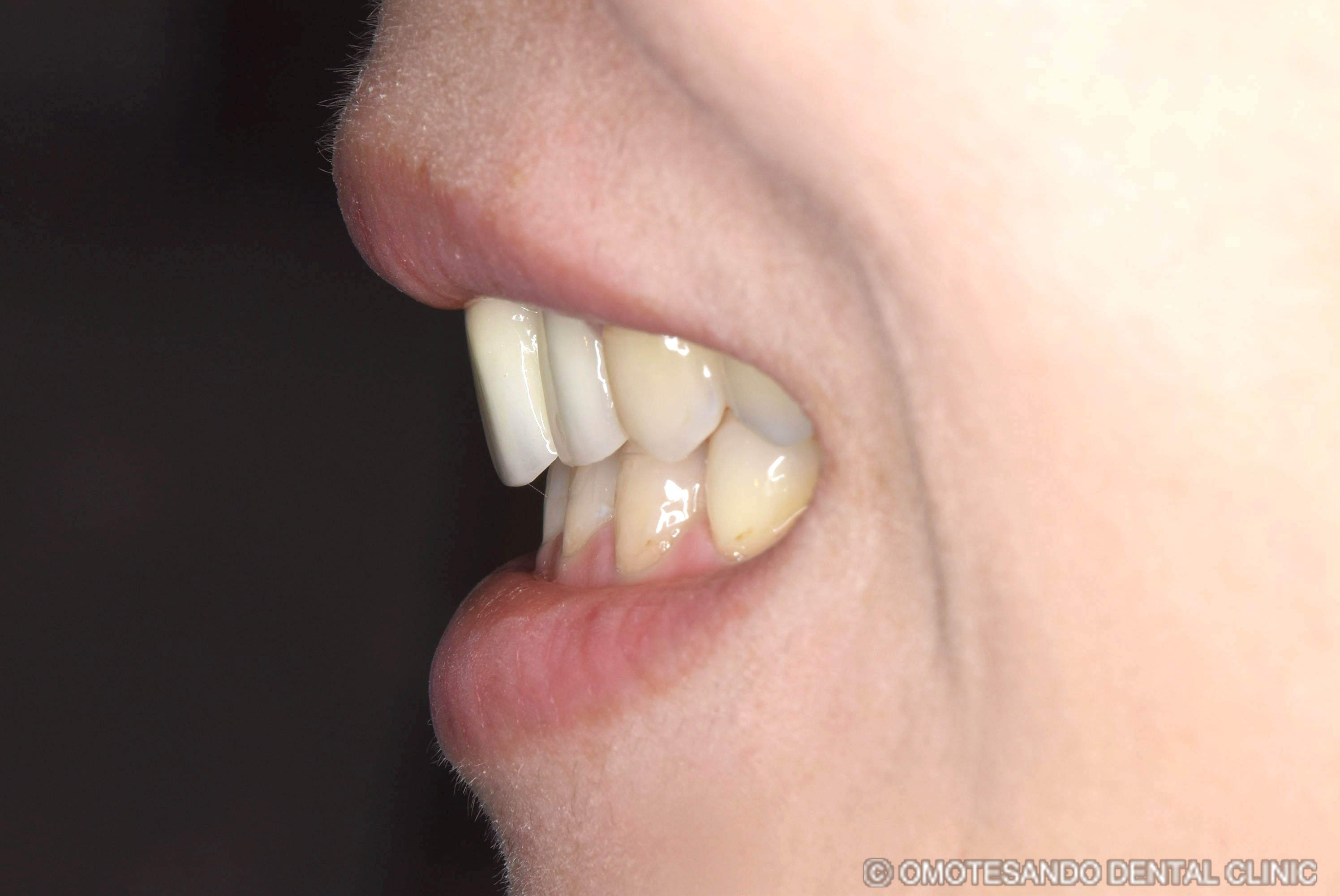 ガミースマイルワイヤー矯正＋セラミック矯正30代女性_サイド_after