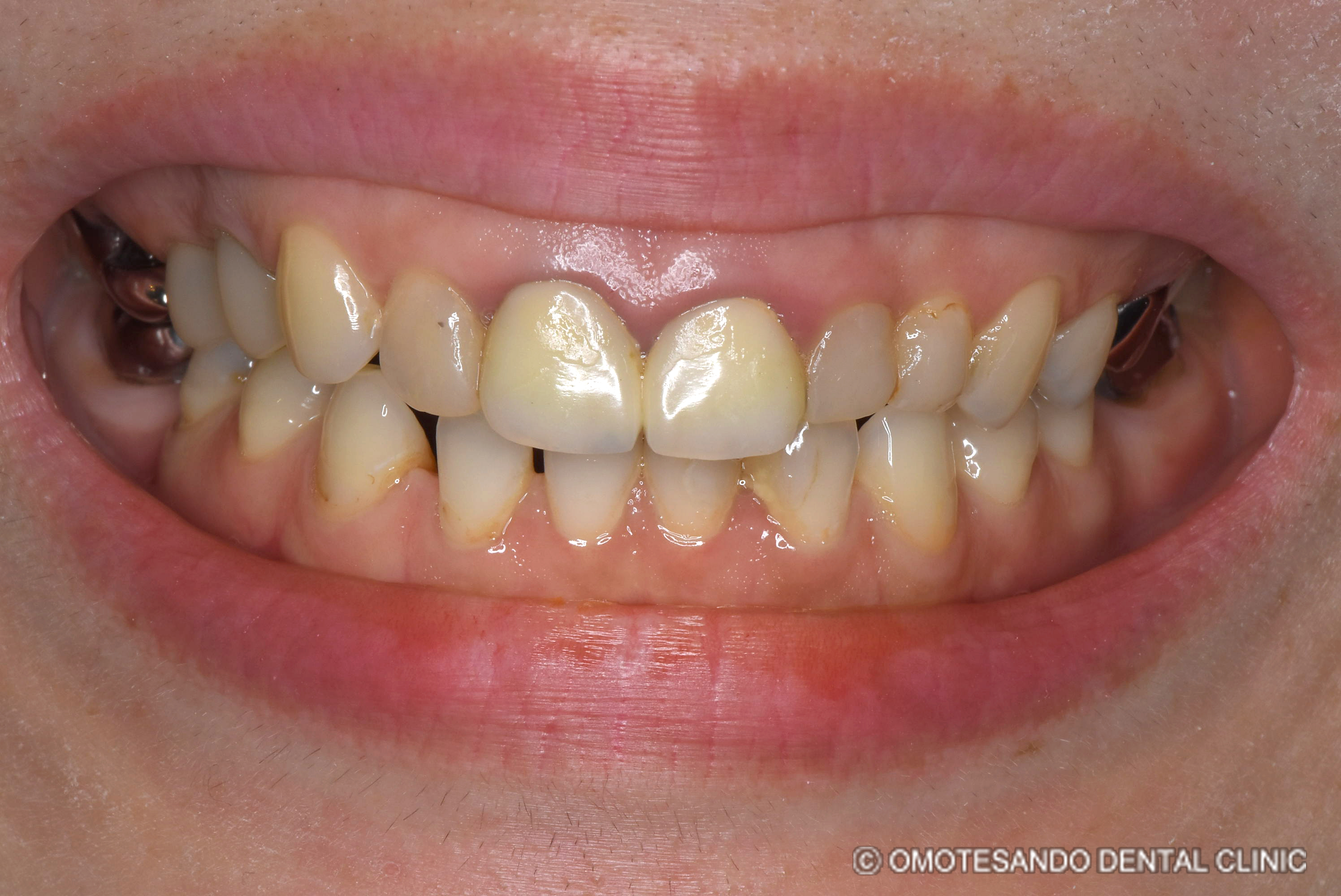 ガミースマイルワイヤー矯正＋セラミック矯正30代女性_フロント_before