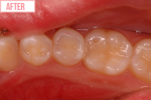 強化プラスチック充てんafter