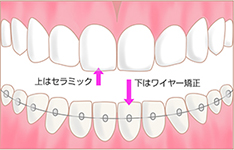 上はセラミック 下はワイヤー矯正