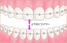 上下共にワイヤー