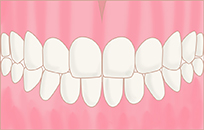 歯並びイメージ