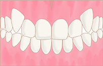 八重歯・乱杭歯(叢生)イメージ