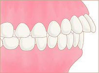 出っ歯(上顎前突)イメージ