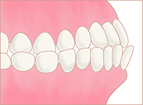 受け口(下顎前突)イメージ