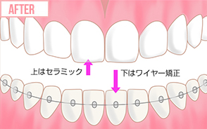 上はセラミック、下はワイヤー矯正