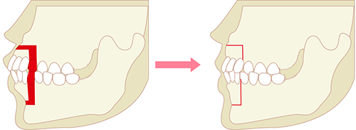 セットバック治療イメージ