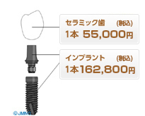 ASTRAインプラント(ツーピース)